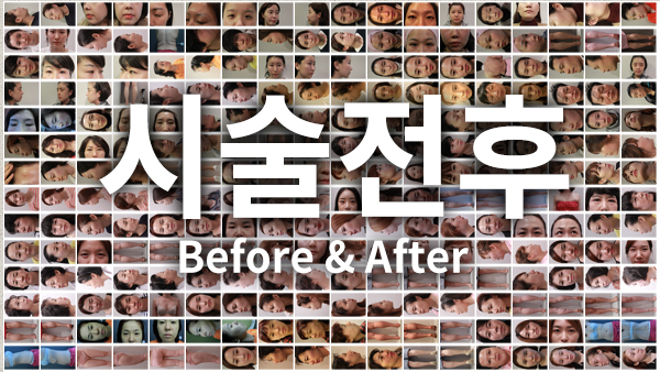 엘린의원 시술 전후 비교