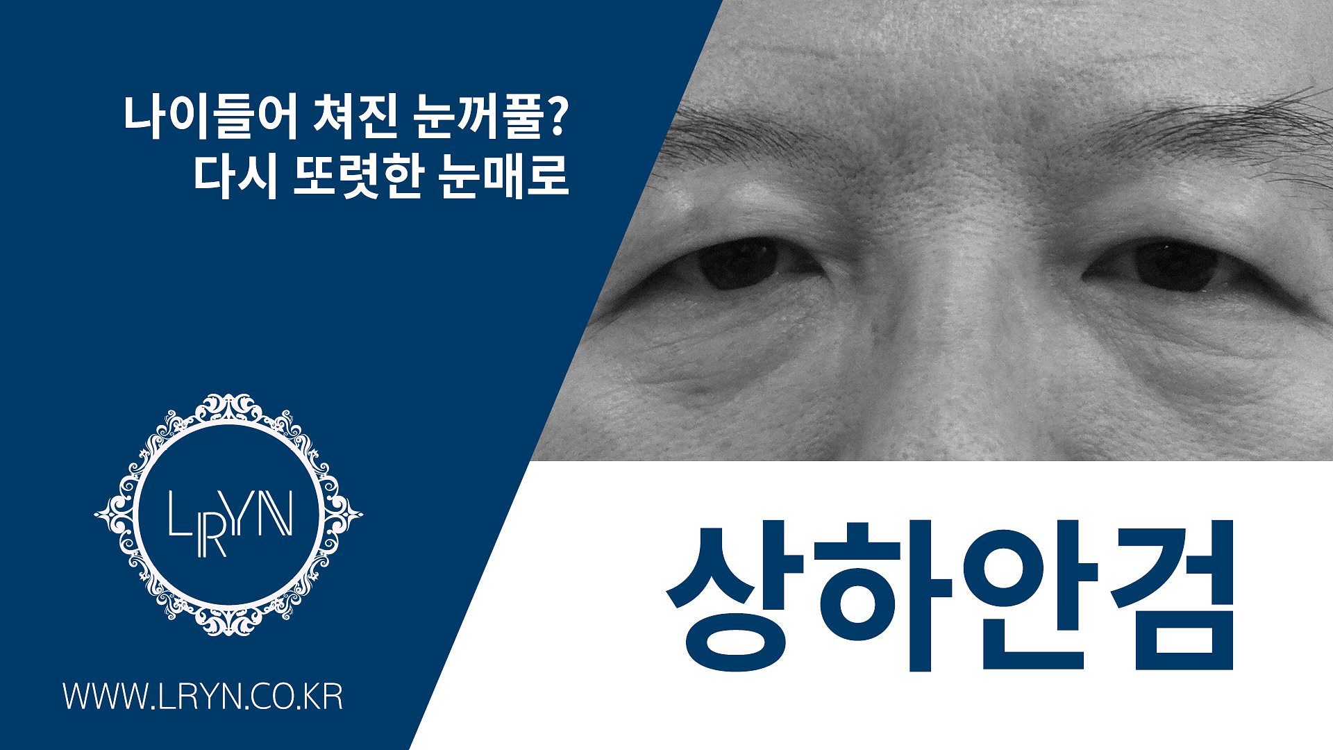 엘린의원, 상하안검 - 처진 눈을 또렷한 인상으로