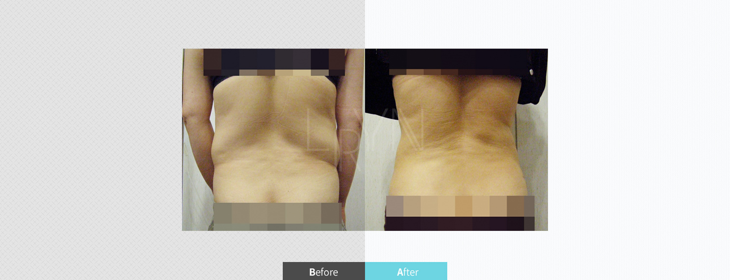 트리플 지방흡입