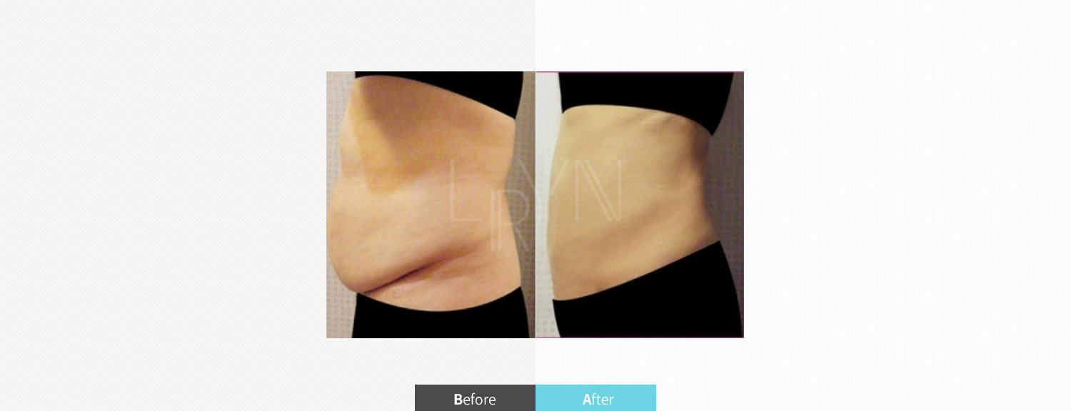 트리플 지방흡입