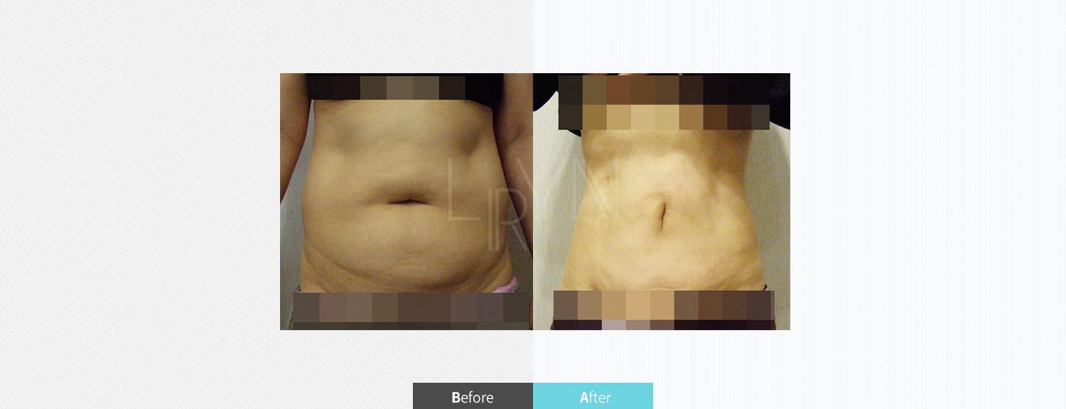 트리플 지방흡입