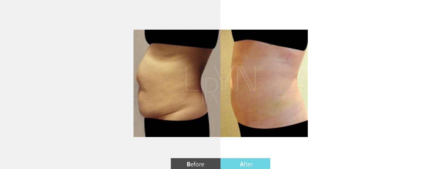 트리플 지방흡입