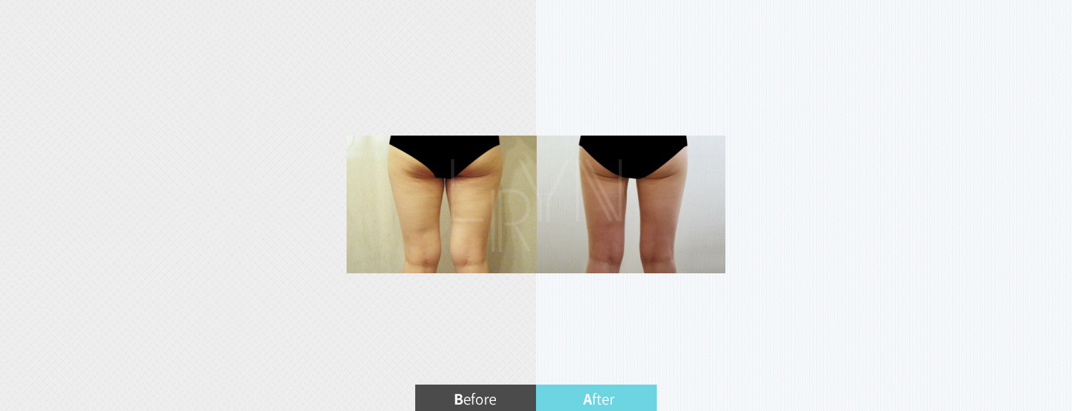 스마트 지방흡입