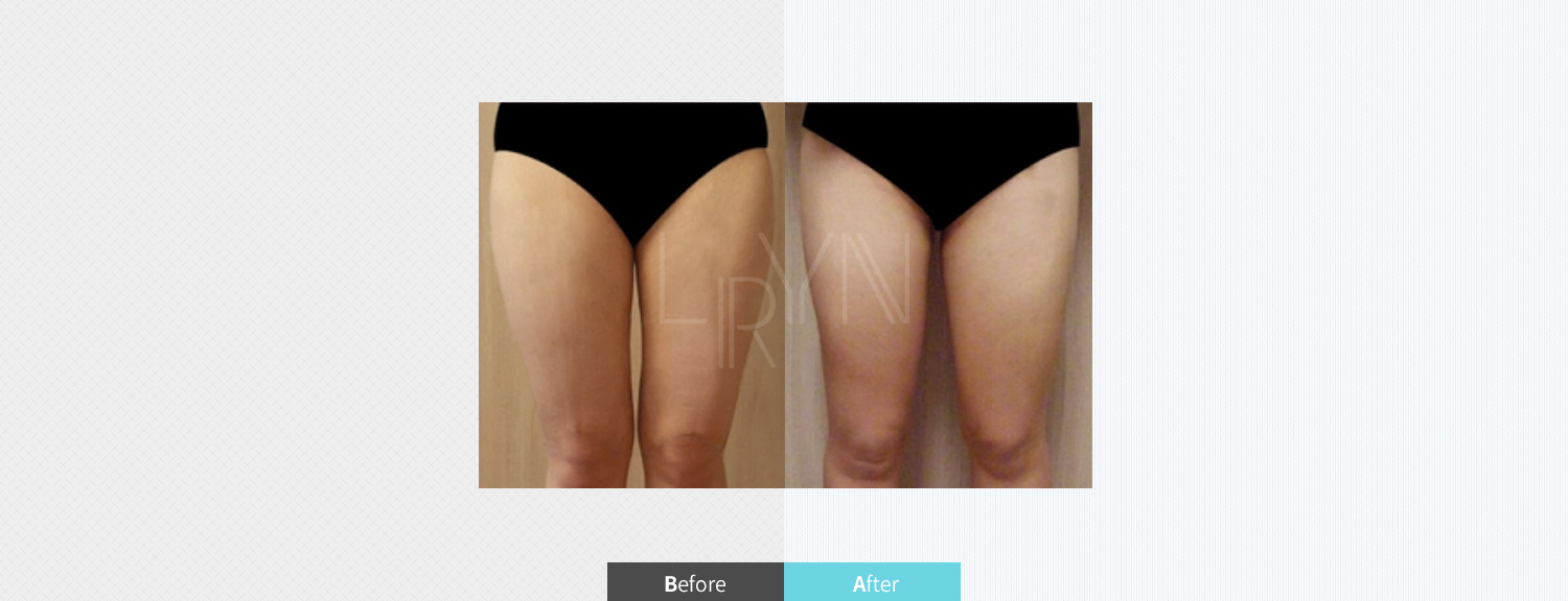 스마트 지방흡입