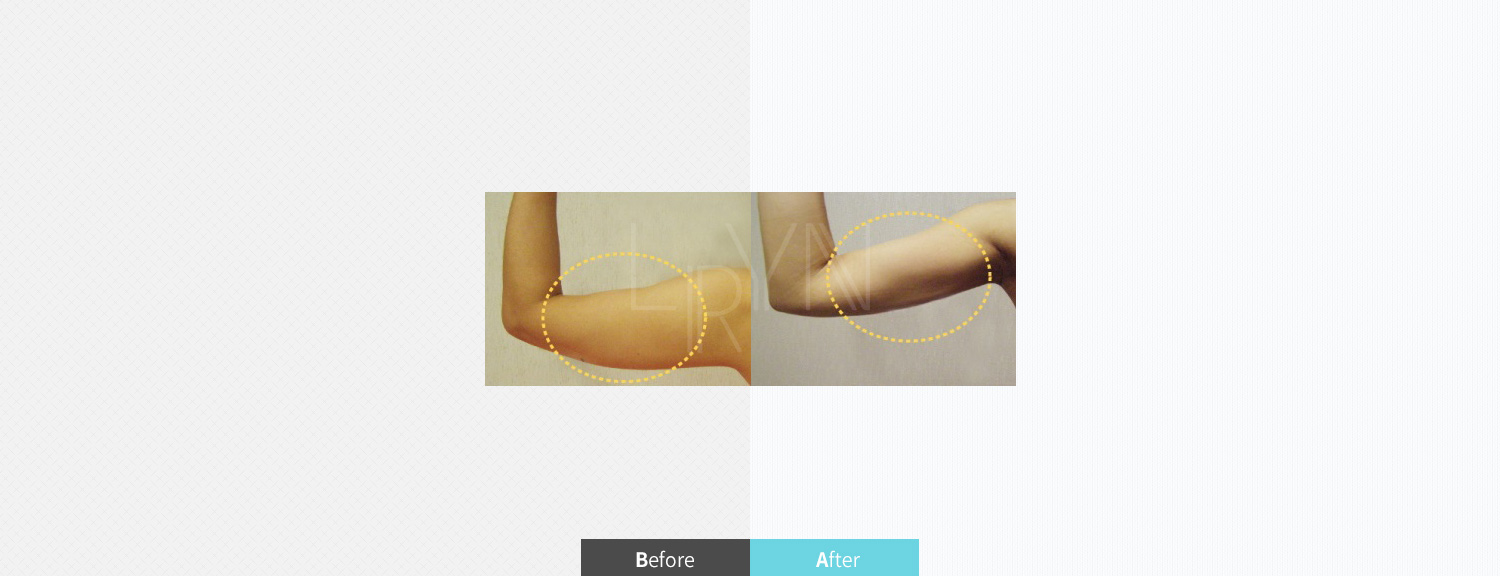 스마트 지방흡입