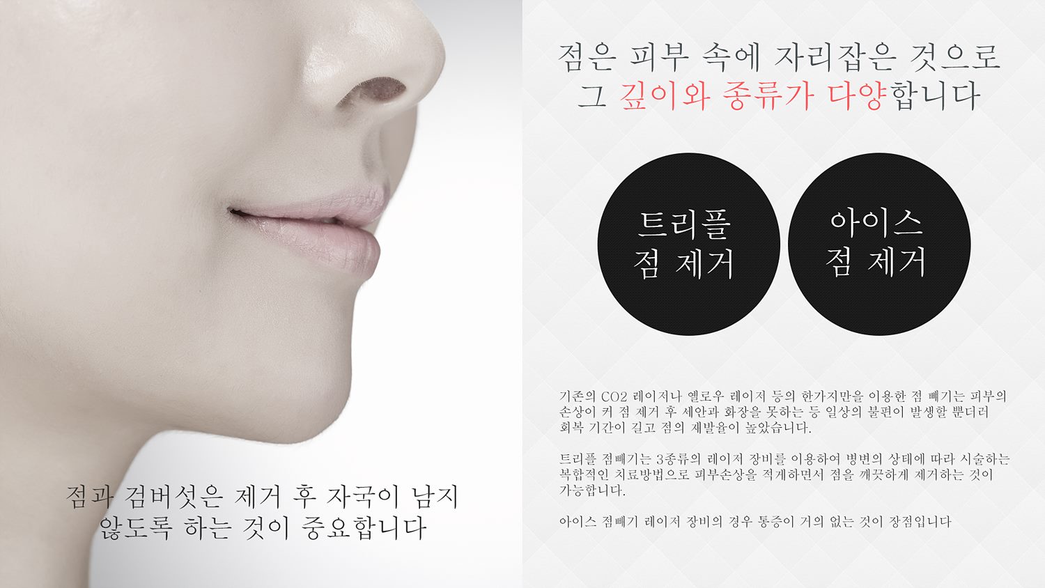 트리플/아이스점제거