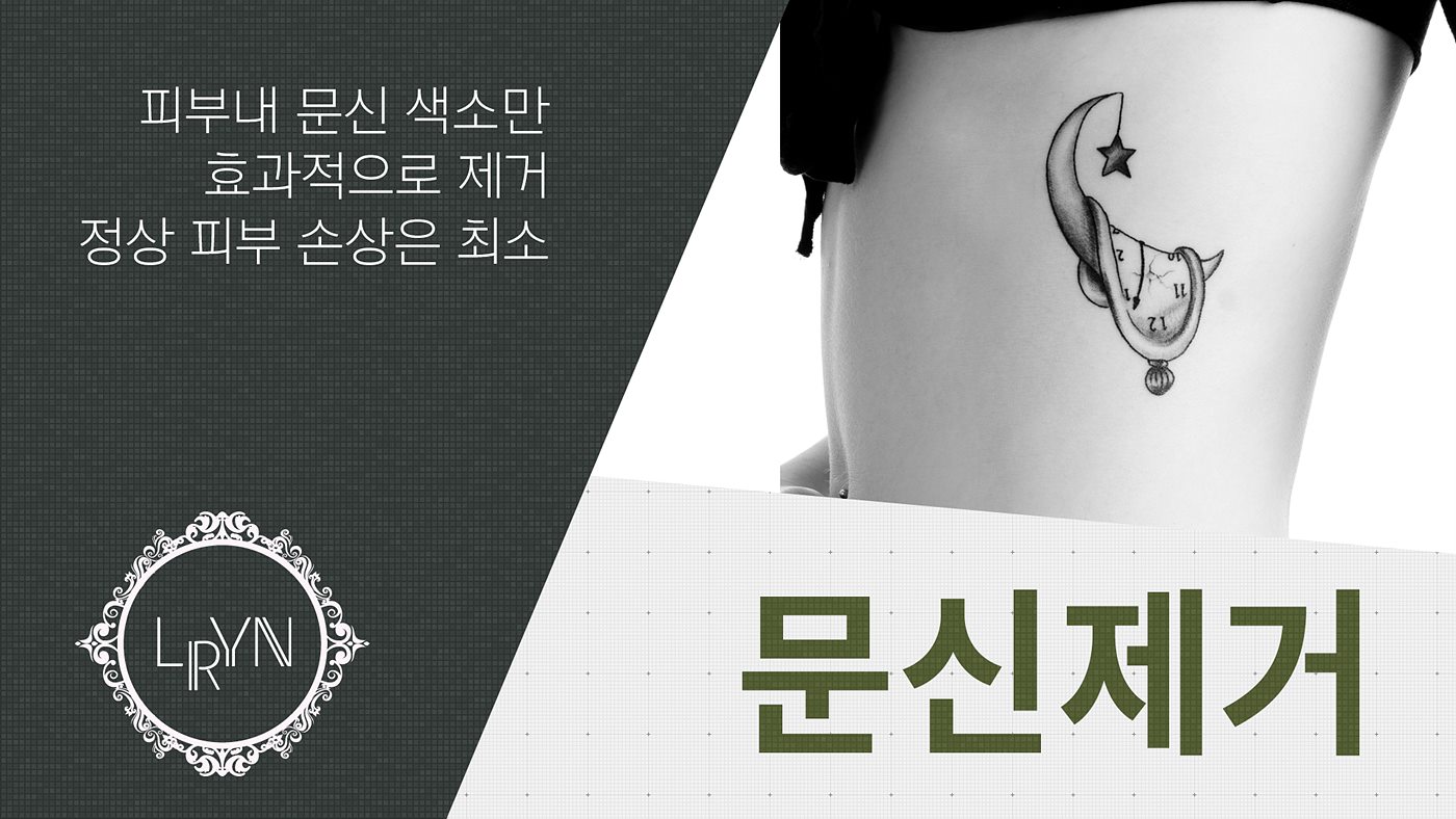 엘린의원, 문신제거 -  피부내 색소만 효과적으로 제거 정상 피부에는 손상은 최소